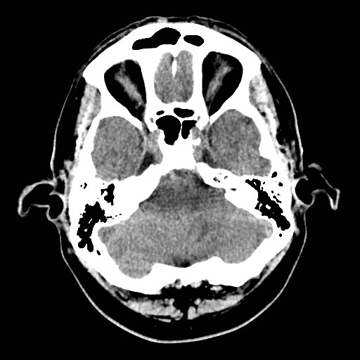 File:Brain metastases from lung cancer (Radiopaedia 83839-99027 Axial non-contrast 7).jpg