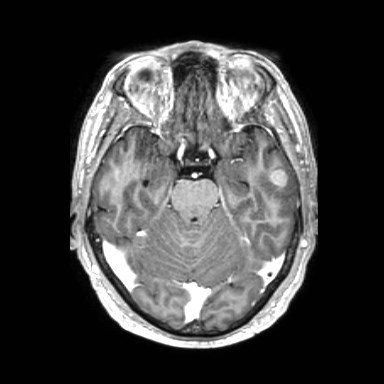 Brain metastases from lung cancer (Radiopaedia 83839-99028 Axial T1 C+ 20).jpg