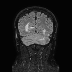 Brain metastases from lung cancer (Radiopaedia 83839-99028 Coronal FLAIR 65).jpg