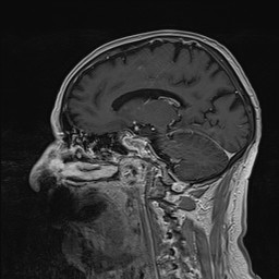 Brain metastasis (Radiopaedia 42617-45761 Sagittal T1 C+ 58).jpg