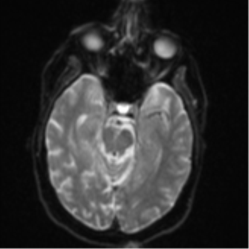Brain metastasis (lung cancer) (Radiopaedia 48289-53179 Axial DWI 10).png