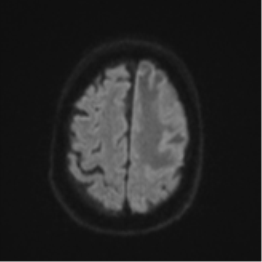 Brain metastasis (lung cancer) (Radiopaedia 48289-53179 Axial DWI 51).png