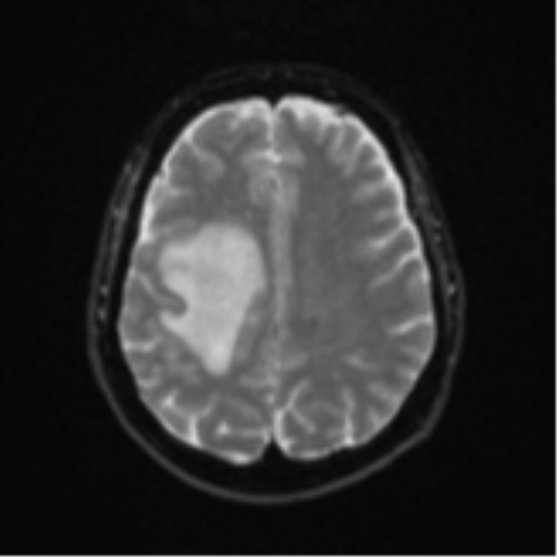 Brain metastasis (sarcoma) (Radiopaedia 47576-52209 Axial DWI 18).png