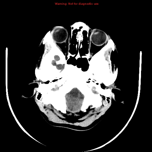 File:Brainstem glioma (Radiopaedia 9444-10123 non-contrast 1).jpg