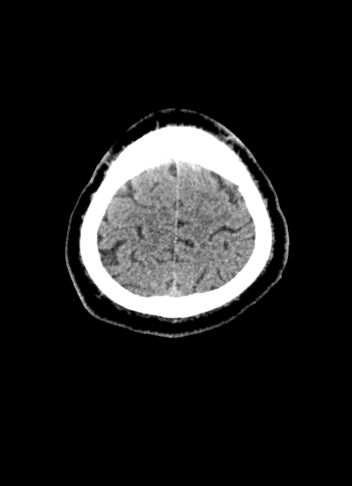 Brainstem hemorrhage (Radiopaedia 81294-94976 Axial non-contrast 11).jpg