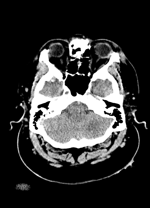 Brainstem hemorrhage (Radiopaedia 81294-94976 Axial non-contrast 50).jpg