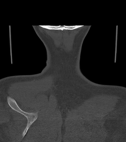 File:Branchial cleft cyst (Radiopaedia 31167-31875 Coronal bone window 62).jpg