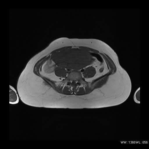 File:Broad ligament fibroid (Radiopaedia 49135-54241 Axial T1 5).jpg