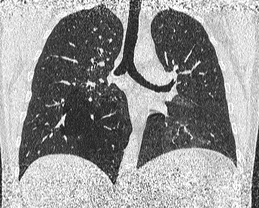 Bronchial atresia (Radiopaedia 58271-65417 Coronal lung window 32).jpg
