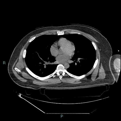 Bronchial carcinoid tumor (Radiopaedia 78272-90870 Axial non-contrast 59).jpg