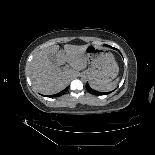 Bronchial carcinoid tumor (Radiopaedia 78272-90870 Axial non-contrast 99).jpg