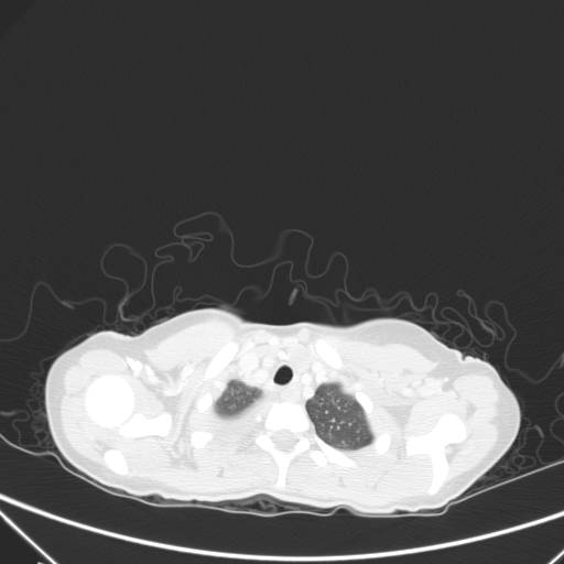 Bronchial mucoepidermoid carcinoma (Radiopaedia 57023-63895 Axial lung window 4).jpg
