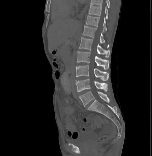 Bronchiectasis in Crohn disease (Radiopaedia 60311-67977 Sagittal bone window 122).jpg
