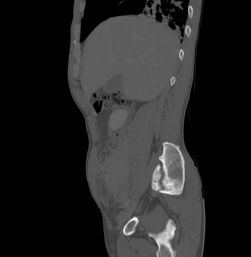 File:Bronchiectasis in Crohn disease (Radiopaedia 60311-67977 Sagittal bone window 57).jpg