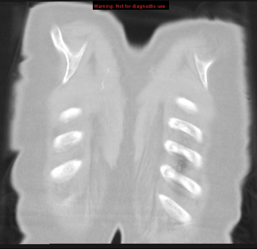 Bronchoalveolar carcinoma (BAC) (Radiopaedia 13436-13392 Coronal lung window 58).jpg