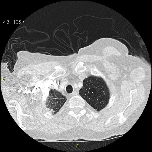 Bronchogenic carcinoma as an incidental finding (Radiopaedia 16453-16130 Axial lung window 105).jpg