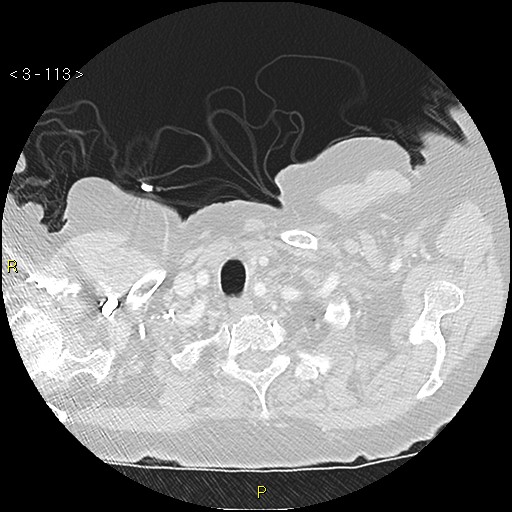 Bronchogenic carcinoma as an incidental finding (Radiopaedia 16453-16130 Axial lung window 113).jpg