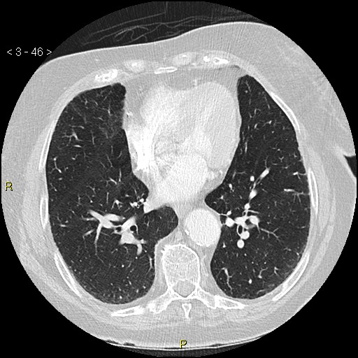 File:Bronchogenic carcinoma as an incidental finding (Radiopaedia 16453-16130 Axial lung window 46).jpg