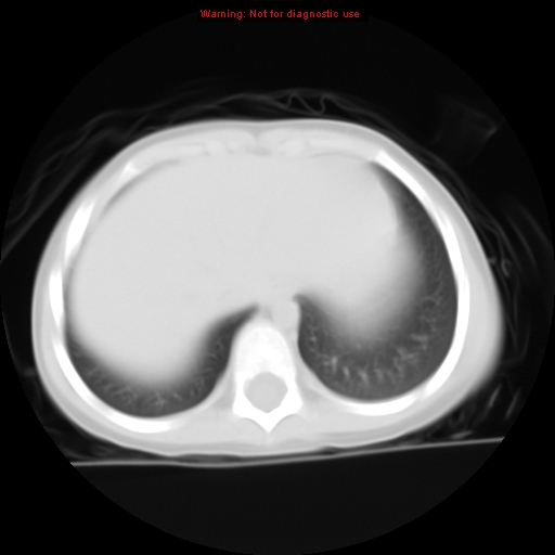 File:Bronchogenic cyst (Radiopaedia 9372-10063 Axial lung window 14).jpg