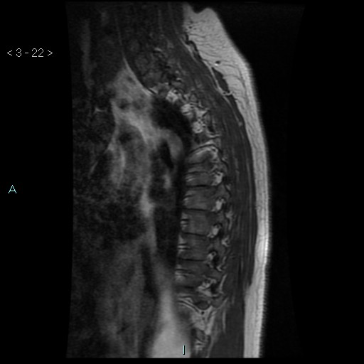 File:Bronchogenic cyst - posterior mediastinal (Radiopaedia 43885-47365 Sagittal T1 22).jpg