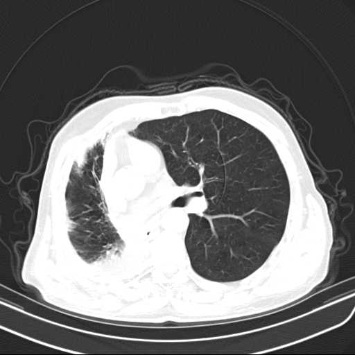 File:Bronchopleural fistula - postoperative complication (Radiopaedia 21020-20947 Axial lung window 26).jpg