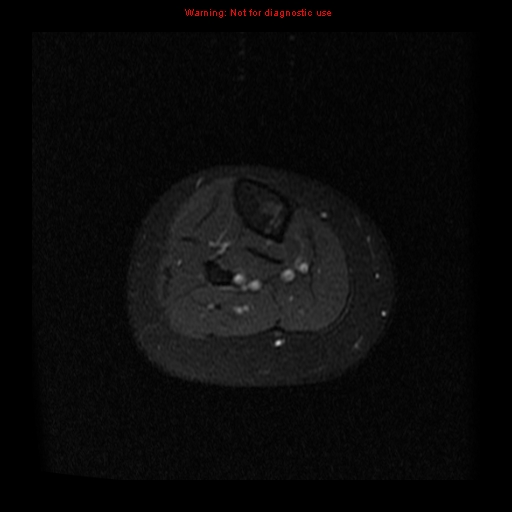 File:Brown tumor (Radiopaedia 12318-12597 Axial T1 C+ fat sat 32).jpg