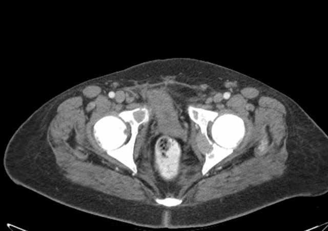 Brown tumors compressing the spinal cord (Radiopaedia 68442-77988 E 120).jpg