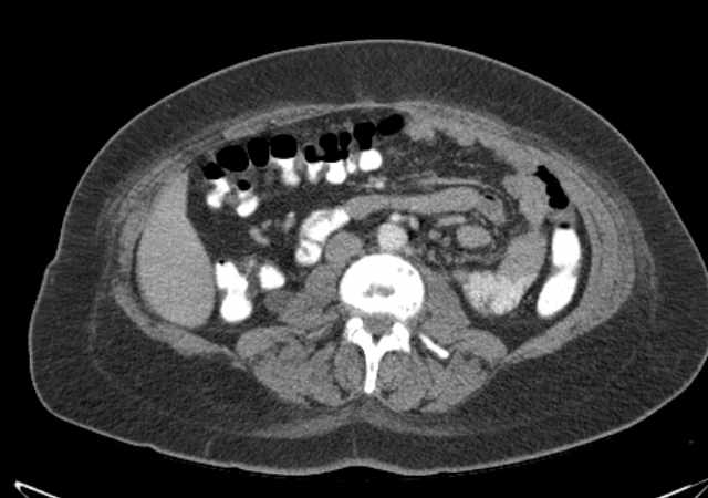 Brown tumors compressing the spinal cord (Radiopaedia 68442-77988 E 62).jpg