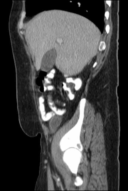 Brown tumors compressing the spinal cord (Radiopaedia 68442-77988 F 15).jpg