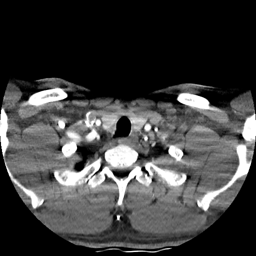 Buccal fat pad arteriovenous malformation (Radiopaedia 70936-81144 D 46).jpg