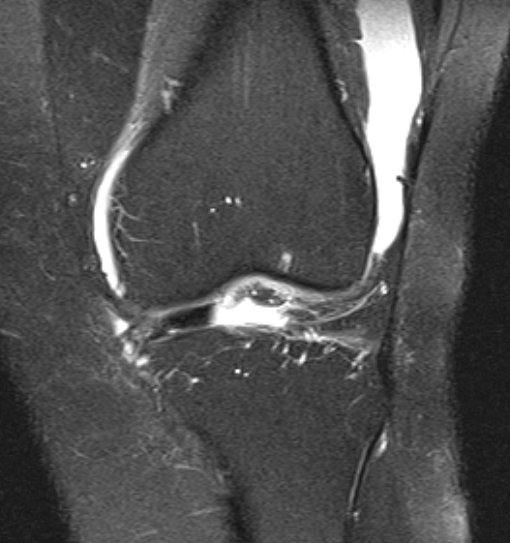 File:Bucket handle tear - medial meniscus (Radiopaedia 79028-91942 Coronal PD fat sat 15).jpg