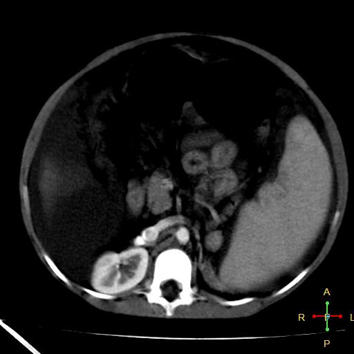 File:Budd-Chiari syndrome (Radiopaedia 23072-23103 C+ arterial phase 12).jpg