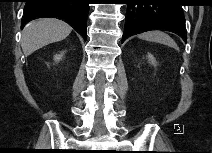 Buried bumper syndrome - gastrostomy tube (Radiopaedia 63843-72577 Coronal Inject 103).jpg