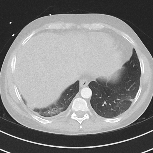Burkitt lymphoma (Radiopaedia 34686-36121 Axial lung window 39).png