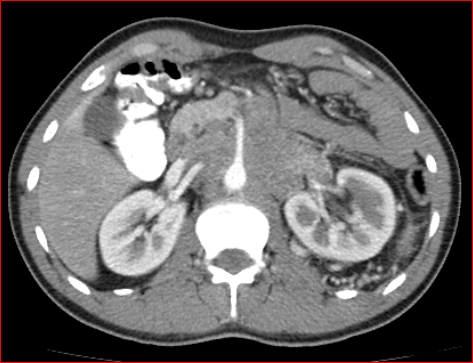 File:Burned-out testicular choriocarcinoma (Radiopaedia 32822-34040 B 6).PNG