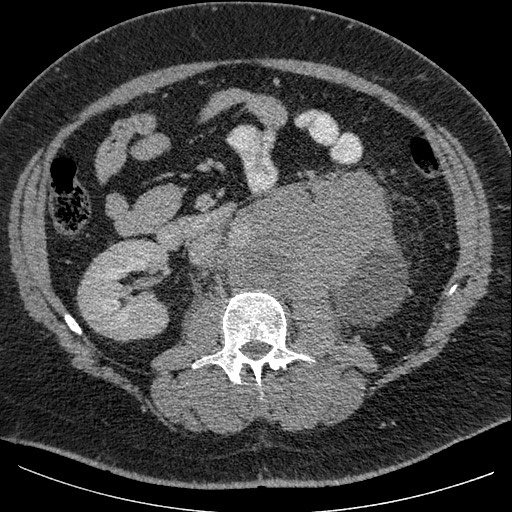 Burned-out testicular seminoma - retroperitoneal nodal metastases (Radiopaedia 62872-71245 A 35).jpg