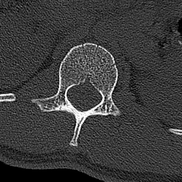 Burst fracture (Radiopaedia 53373-59357 Axial bone window 11).jpg