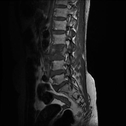 File:Burst fracture - lumbar spine (Radiopaedia 72877-83541 Sagittal T1 3).jpg