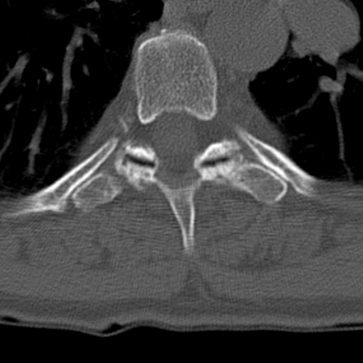 Butterfly vertebrae with kyphoscoliosis (Radiopaedia 14257-14133 Axial bone window 2).jpg