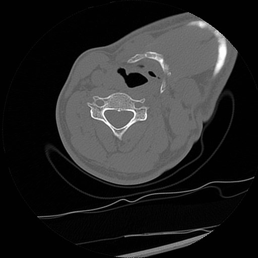 C1-C2 "subluxation" - normal cervical anatomy at maximum head rotation (Radiopaedia 42483-45607 Axial non-contrast 4).jpg