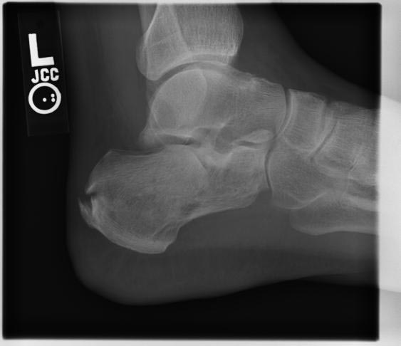File:Calcaneal fracture (Radiopaedia 11269-11633 Lateral 1).jpg
