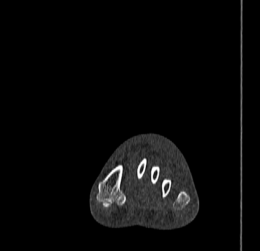 Calcaneal fracture - Sanders type 4 (Radiopaedia 90179-107370 Coronal bone window 30).jpg