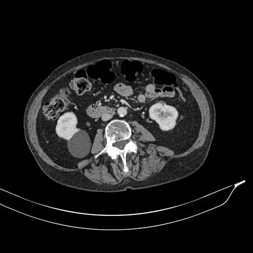 Calcified adrenal glands and Spigelian hernia (Radiopaedia 49741-54988 A 113).jpg