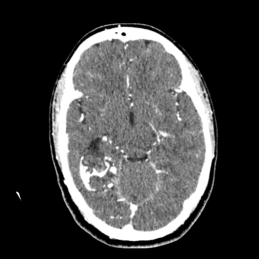 File:Calcified cerebral hydatid cyst (Radiopaedia 65603-74717 Axial with contrast 29).jpg