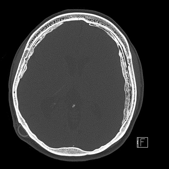Calcified chronic subdural hematoma (Radiopaedia 77374-89492 Axial bone window 73).jpg