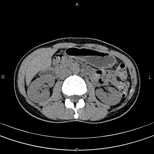 File:Calcified hepatic hydatid cyst (Radiopaedia 83870-99072 Axial non-contrast 79).jpg