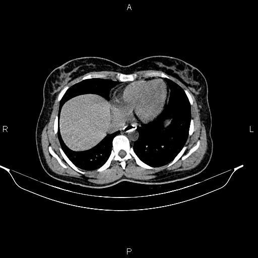 File:Calcified hepatic hydatid cyst (Radiopaedia 84672-100095 Axial non-contrast 11).jpg
