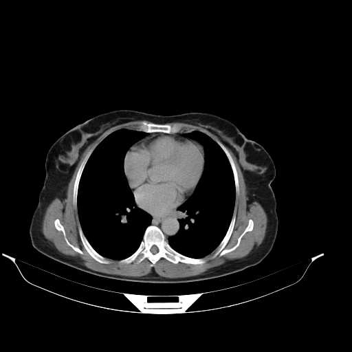 File:Calcified hydatid cyst of the liver (Radiopaedia 21212-21112 Axial C+ delayed 3).jpg