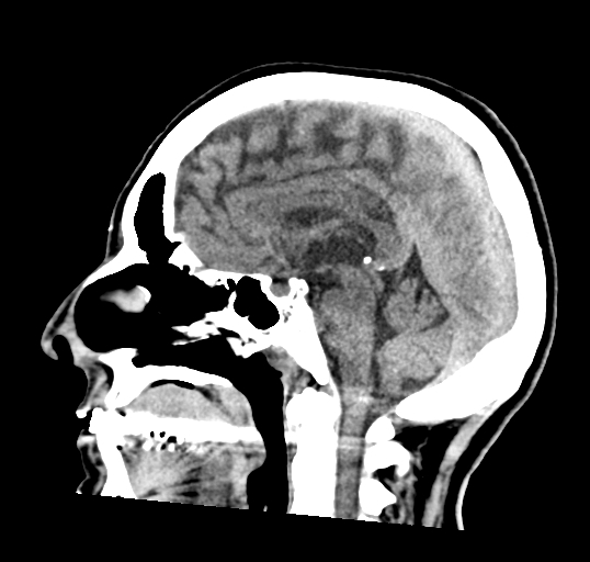 File:Calcified meningioma (Radiopaedia 74361-85243 D 1).jpg