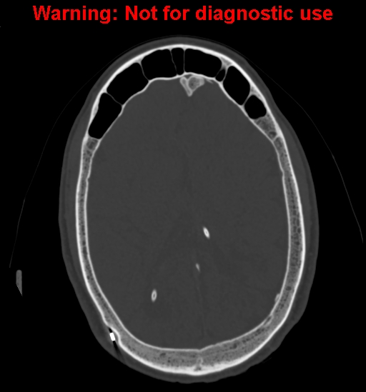 Calvarial thickening from chronic shunting (Radiopaedia 60079-67637 Axial bone window 109).jpg